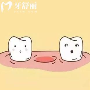 70歲老人適合種牙還是鑲牙？