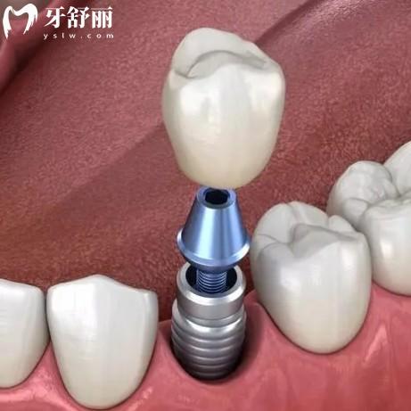 種完牙刷牙要注意什么？學(xué)會正確清潔方法種植牙再用10年