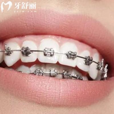 戴牙套有幾個階段?疼不疼?看完本文就知道了
