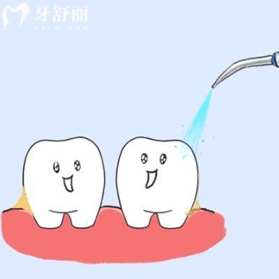 洗牙會損傷牙齒嗎,不少人存在誤解,揭秘洗牙對牙齒的好處