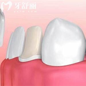 德國進口全瓷牙有哪些品牌？五大品牌性能/價格/壽命一文解析