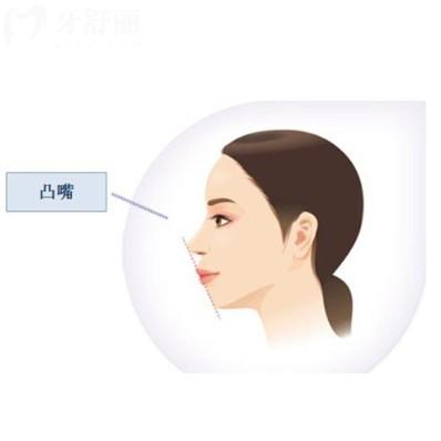 骨性凸嘴帶牙套牙齒矯治器有用嗎？如何矯正比較好