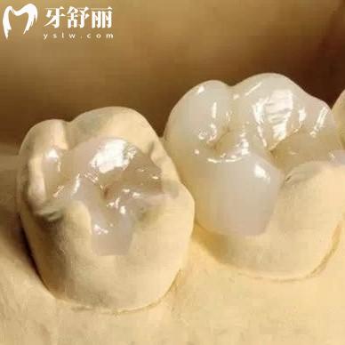 樹脂補(bǔ)牙和嵌體補(bǔ)牙哪個(gè)好?需要了解下區(qū)別/保持時(shí)間和價(jià)格哦