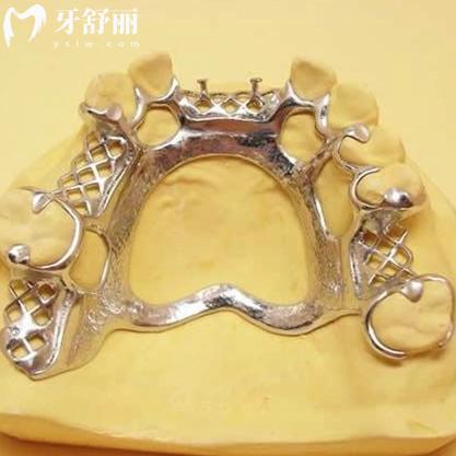 鈦合金牙托和純鈦牙托哪個更好?從它們的優(yōu)點和價格對比下