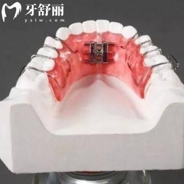 擴(kuò)弓矯正前后臉型對(duì)比，揭秘矯正擴(kuò)弓后變v臉還是u臉