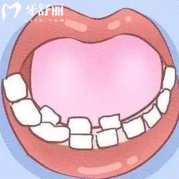 雙排牙為何越來(lái)越多了？造成雙排牙的原因及治療方式給大家