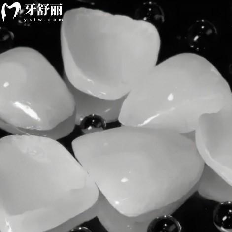 牙貼面做幾顆合適？來看1顆/4顆/6顆/8顆成效圖對比