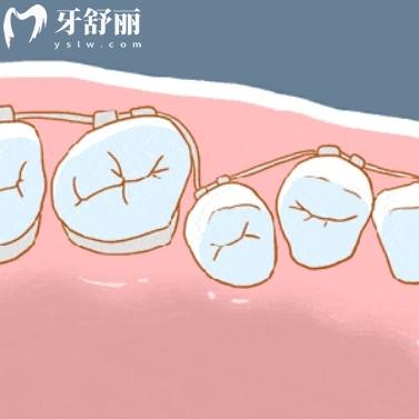 矯正過的牙齒反彈了怎么辦？二次正畸難度系數(shù)高傷害大