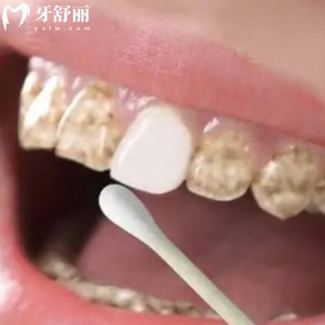 四環(huán)素牙怎樣才能變白?來看看修復(fù)比較好的幾種方法