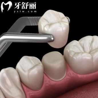牙齒不整齊做烤瓷牙能變整齊嗎？又省錢又快真的靠譜嗎