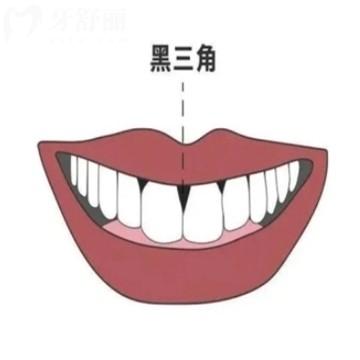 牙齒黑三角怎么形成的?馬上揭曉可以修復補救嗎？