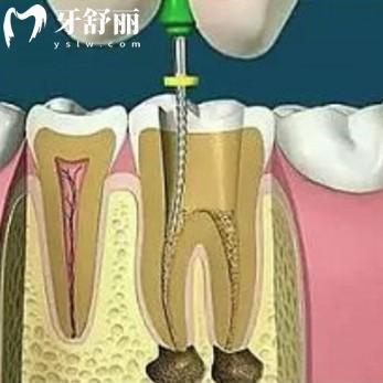 根管治療會造成牙根隱裂嗎?會出現(xiàn)幾種情況并附上治療措施