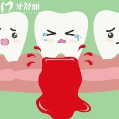 牙齦出血要警惕三種?。貉乐懿?血液病/全身疾病不容小覷