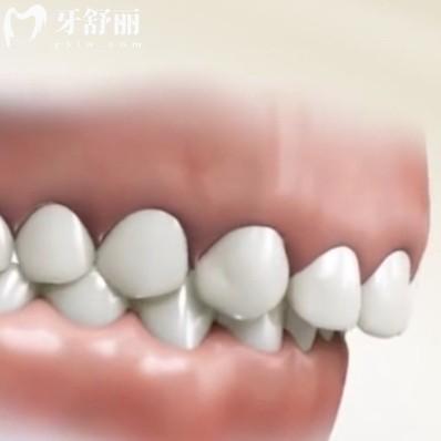 牙齒深覆合會(huì)造成顳下頜關(guān)節(jié)紊亂嗎?答會(huì)的!影響臉型很有必要矯正
