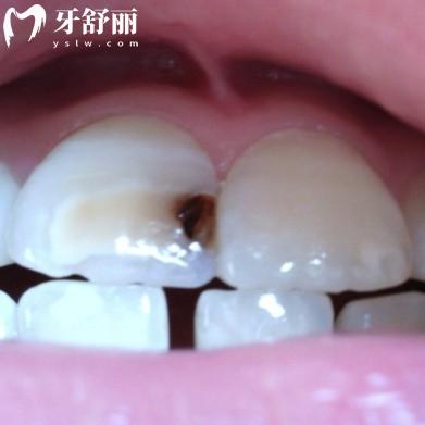 2顆門牙中間內(nèi)部黑了怎么補?要從多個方面進行處理修復