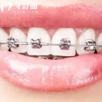 牙套多少錢價格表2024全新版，附金屬透明牙套排行前十
