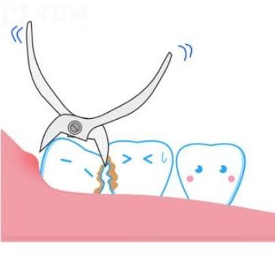 微創(chuàng)拔牙與普通拔牙的區(qū)別,下面深入解析下