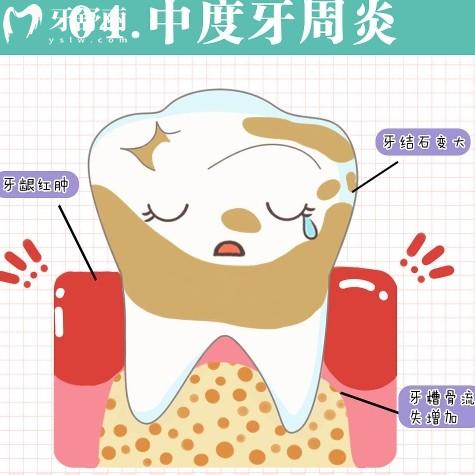 牙周炎一輩子都治不好嗎？怎么樣才能徹底根除？
