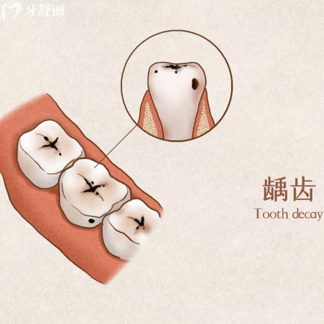 牙齒爛到什么程度就不能補(bǔ)了？盤(pán)點(diǎn)不同程度的蛀牙修復(fù)方法