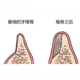 缺牙多年牙槽骨吸收還能種牙嗎？多種方式還能種好牙
