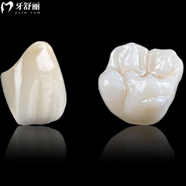 800元的全瓷牙能用嗎？盤點正規(guī)全瓷牙有哪些品牌以及價格表
