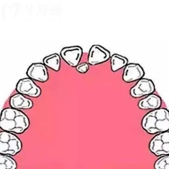 成人多生牙拔除有什么風(fēng)險(xiǎn)嗎？