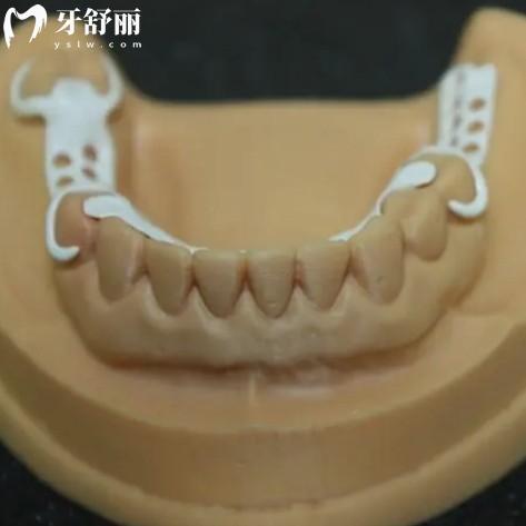 解答peek活動義齒支架的優(yōu)缺點/使用壽命/價格從中看好不好