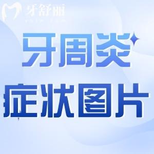 牙周炎圖片及癥狀圖片大全圖解:主要癥狀及怎么治療方法分享