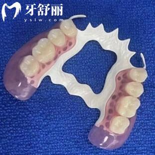 假牙hpp支架和維他靈支架哪個(gè)好?從優(yōu)缺點(diǎn)和價(jià)格了解下