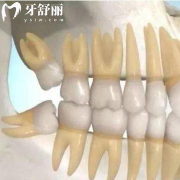 埋伏牙一定要拔嗎？盤點必拔和不用拔智齒類型