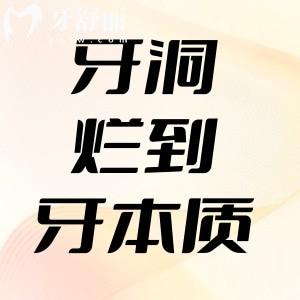 牙洞爛到牙本質(zhì)會(huì)怎么樣？