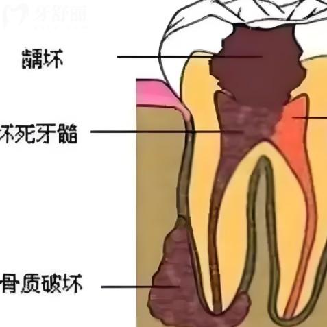 急性牙髓炎和慢性牙髓炎有什么區(qū)別？