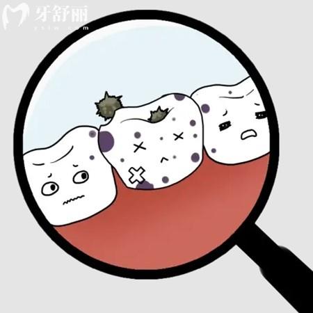 鄰面齲齒已經(jīng)有洞了怎么辦?有填充/冠修復(fù)/拔牙幾種治療方式哦