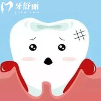 牙周炎會導(dǎo)致年紀輕輕掉牙嗎?怎么治療比較好呢