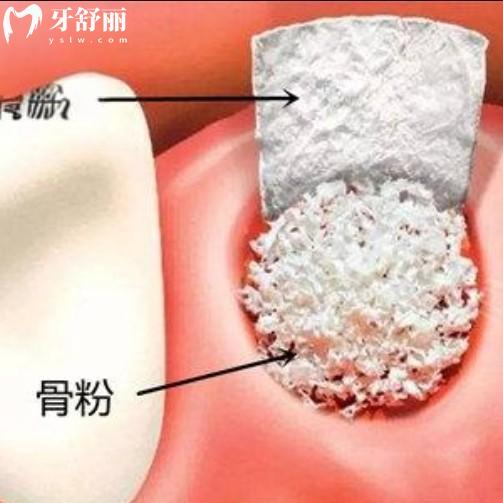 種植牙植骨粉是什么？關(guān)于愈合時(shí)間/價(jià)格收費(fèi)/維持多久等解答