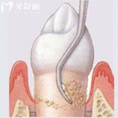 齦下刮治能治好牙周炎嗎?可以緩解很有必要做且要做2-4次