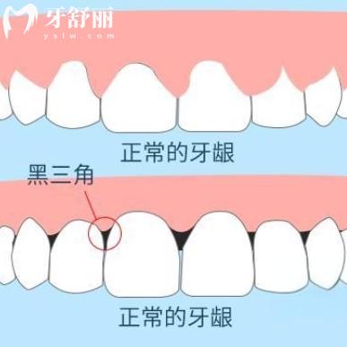 牙齦萎縮植骨能有用嗎？牙齦萎縮的治療方式整理