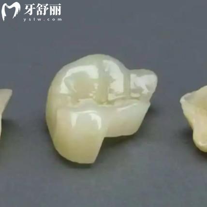 補(bǔ)牙選嵌體和牙冠哪個(gè)更好？從使用壽命/美觀性/價(jià)格多方面對(duì)比