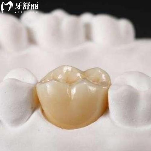 烤瓷牙掉了怎么辦可以粘回去嗎？牙冠脫落原因和延長使用壽命一文可知