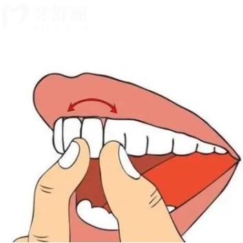 牙齒松動能自己嗎？一度二度三度松動都是如何治療的？