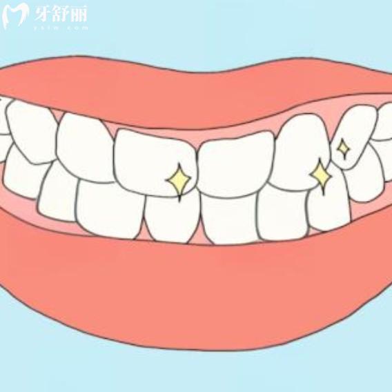 30歲做了滿口烤瓷牙能用一輩子嗎？老了還能用嗎？
