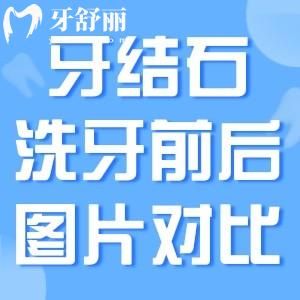 牙結(jié)石洗牙前后圖片對比:不洗危害多多洗一次才幾十塊不貴哦!