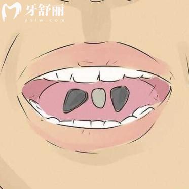 沒想到嗑瓜子竟是口腔殺手，盤點瓜子對牙齒的傷害