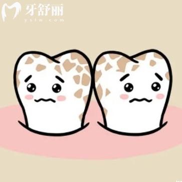 氟斑牙能洗掉嗎？漂白/貼面/牙冠三種美白方式對比