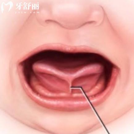 舌系帶矯正術(shù)較好年齡是多少？點(diǎn)擊自測孩子系帶短不短