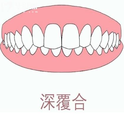 牙齒深覆合不矯正將來會(huì)怎么樣?會(huì)影響臉型和生活質(zhì)量后果嚴(yán)重有必要矯正哦