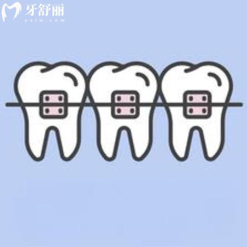 幾顆牙齒可以矯正嗎？關(guān)于局部矯正費用、牙套、周期解讀