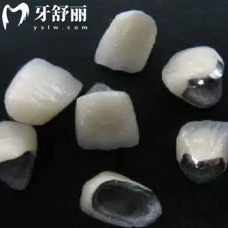 200塊的烤瓷牙能用嗎？想要長期用還是要選這幾種