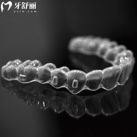 可麗爾隱形矯正怎么樣?優(yōu)缺點(diǎn)價(jià)格看是成效好的國(guó)產(chǎn)品牌哦!
