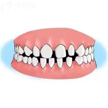 孩子牙縫大是什么原因？需要現(xiàn)在干預(yù)矯正嗎？